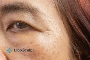 Cryopen: The Revolutionary Treatment for Age Spots Unveiled 2 Are age spots Epping giving you low self esteem? Contact us today!