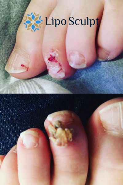 Wart removal customer results from Lipo Sculpt Epping